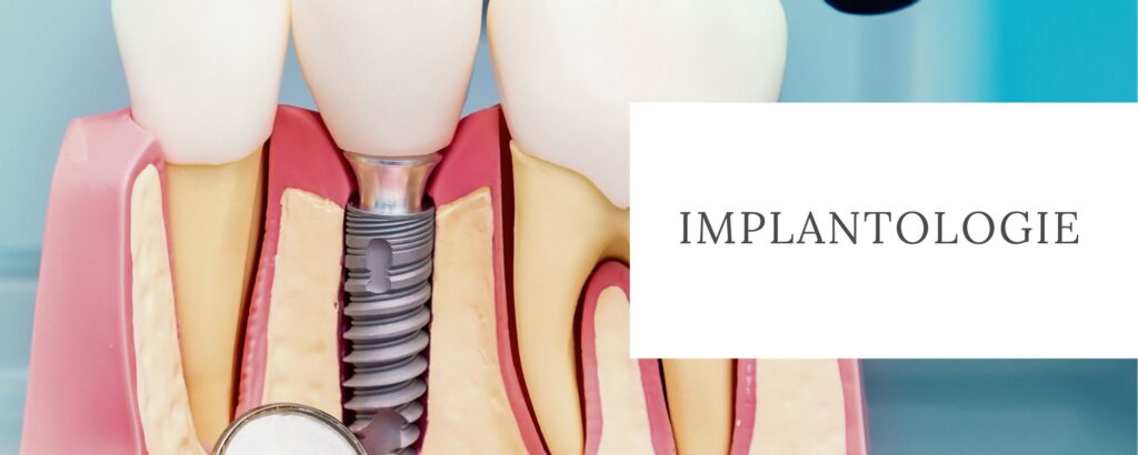 implantologie Cabinet Dentaire de la Lone - dentiste - Boulbon