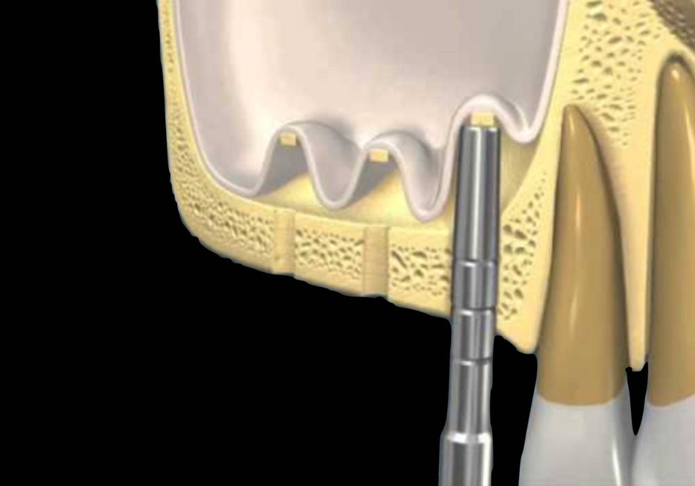 Methode Summer Cabinet Dentaire de la Lone - dentiste - Boulbon
